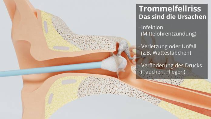 Trommelfellriss - Ursachen