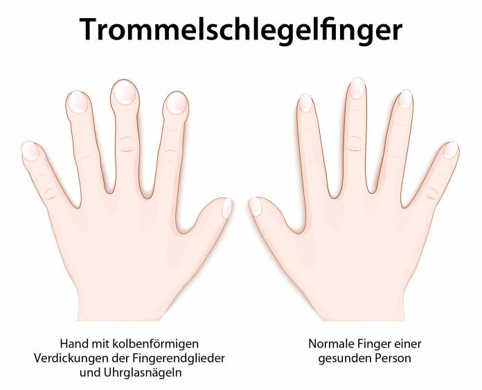 Trommelschlegelfinger