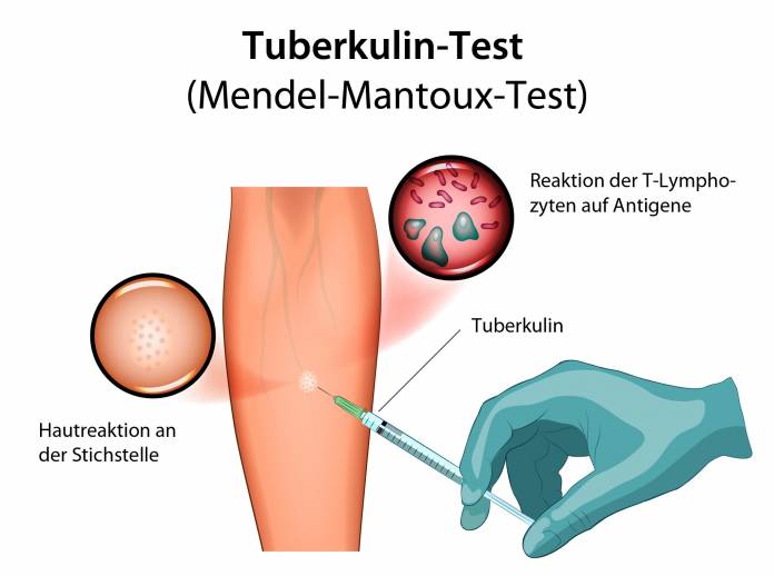 Tuberkulin-Test