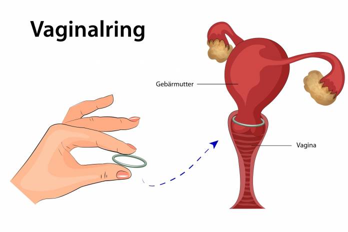 Vaginalring
