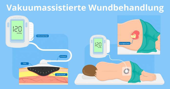 vakuumassistierte Wundbehandlung