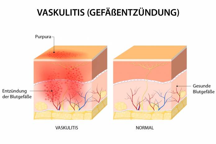 Vaskulitis (Gefäßentzündung)