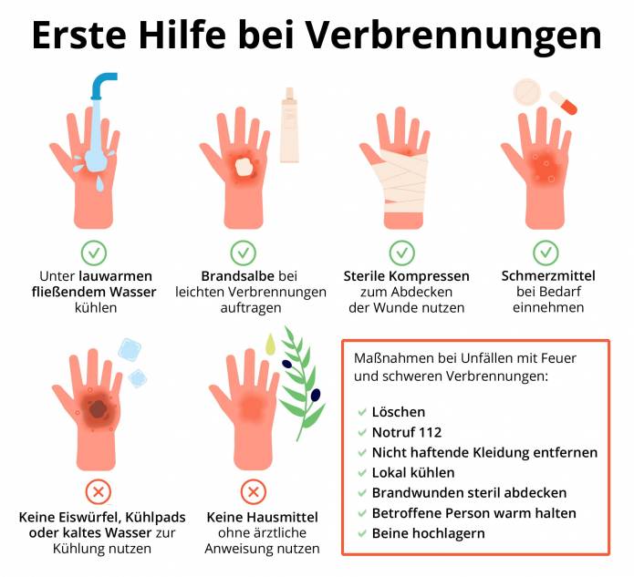 Erste Hilfe bei Verbrennungen