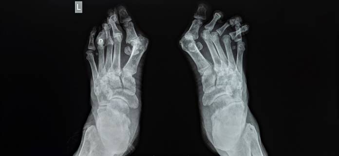 Röntgenaufnahme von verformten Fußzehen