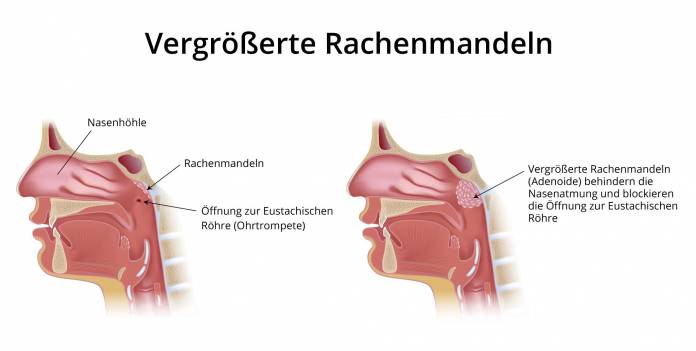 Vergrößerte Rachenmandeln (Adenoide)