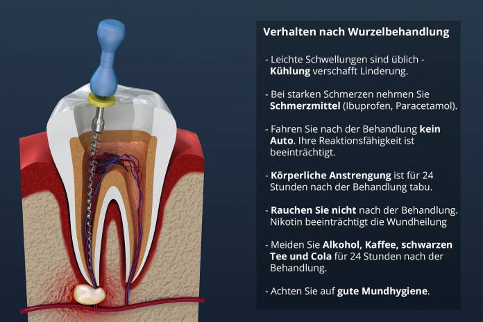 Verhalten nach Wurzelbehandlung