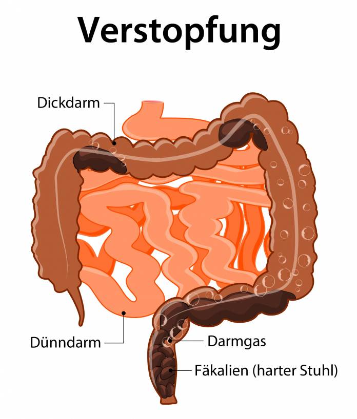 Verstopfung (Obstipation)