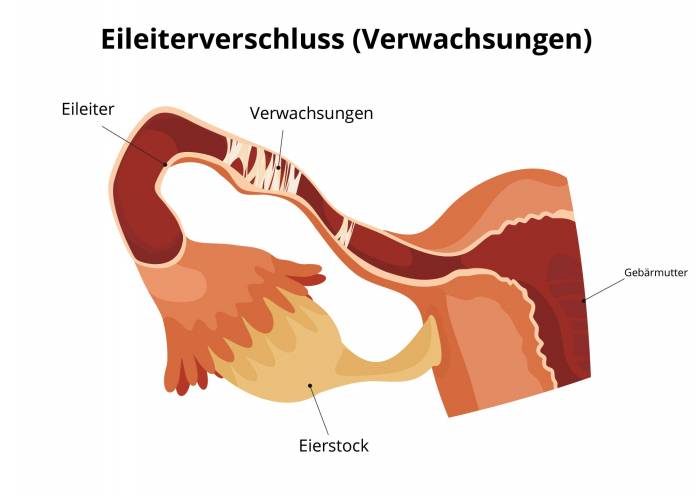 Verwachsungen eines Eileiters