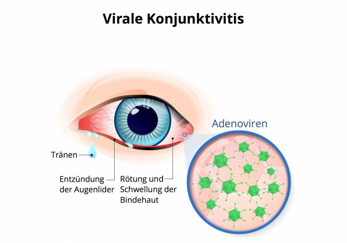 Virale Bindehautentzündung