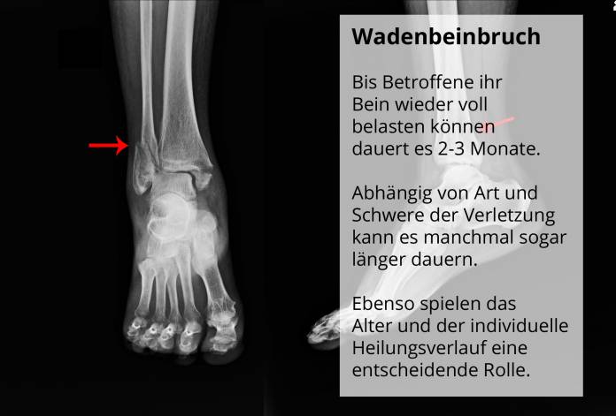 Wieder gehen nach Wadenbeinbruch