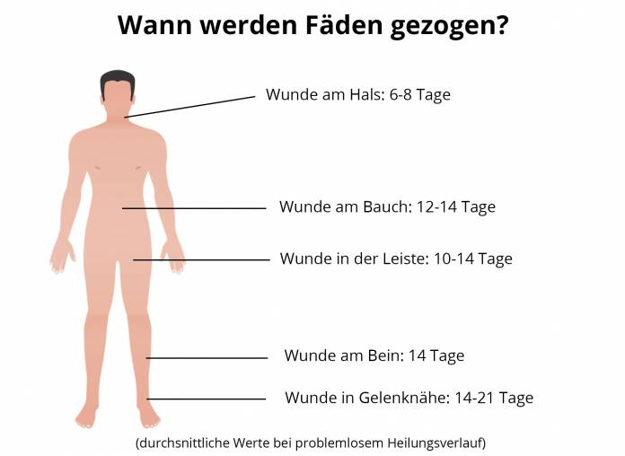 Wann werden Fäden gezogen?