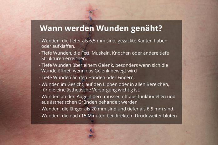 Wann müssen Wunden genäht werden?