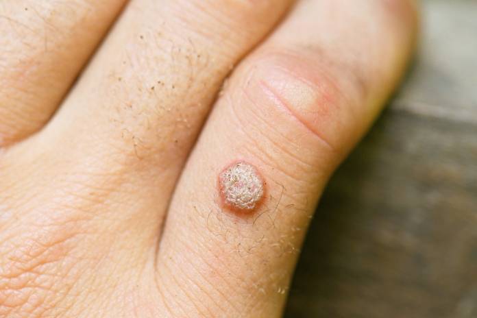 Warze unterm fingernagel entfernen