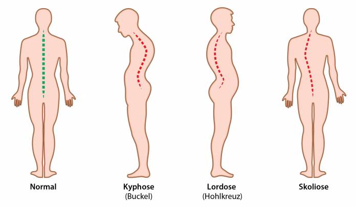 Deformitäten der Wirbelsäule