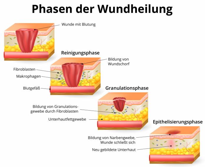 Phasen der Wundheilung