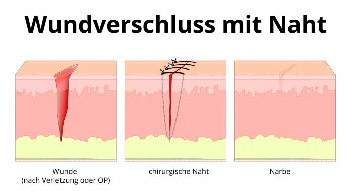 Wundverschluss mit Naht