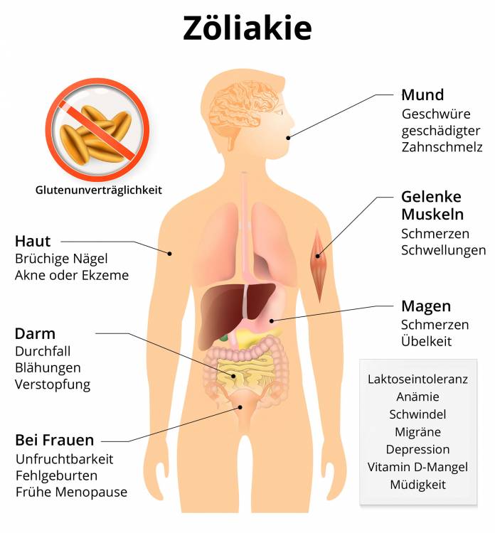 Symptome der Zöliakie