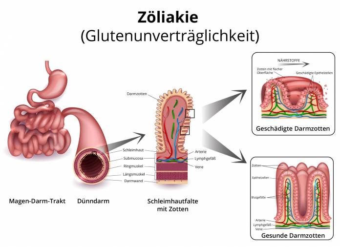 Zöliakie (Glutenunverträglichkeit)