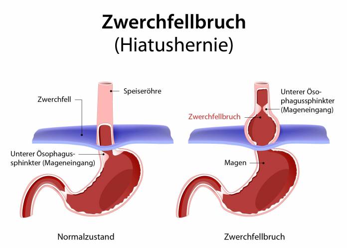 Zwerchfellbruch (Hiatushernie)