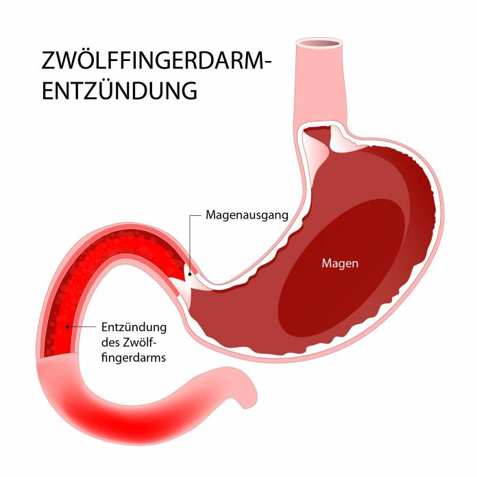 Zwölffingerdarmentzündung